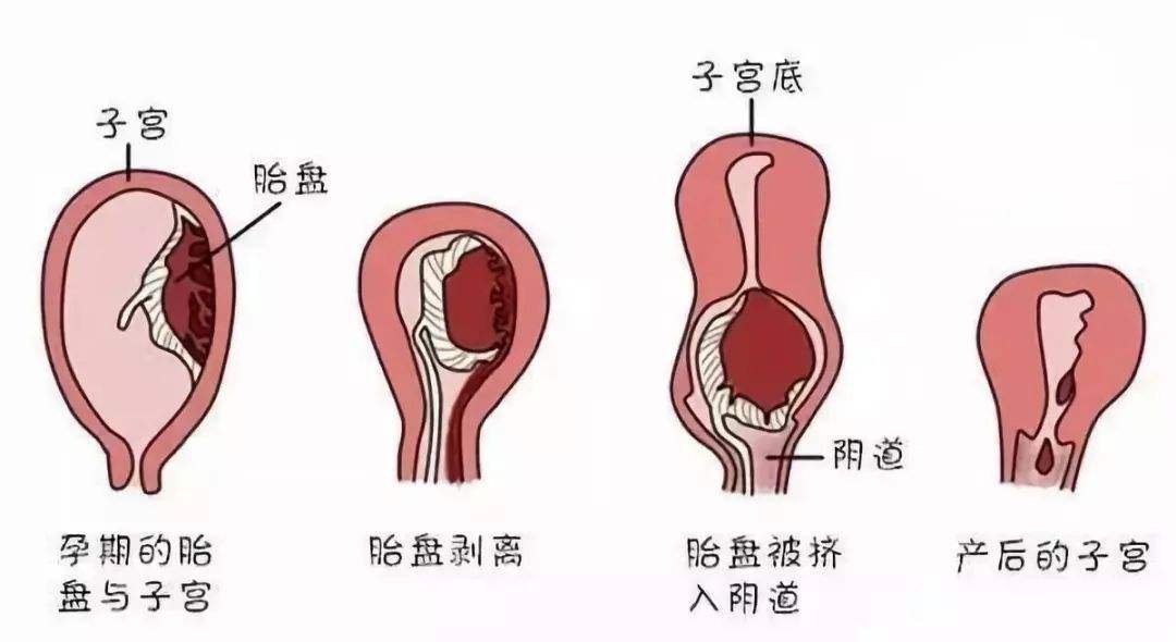 三个月引产需要住院几天，引产过程与住院时长解析